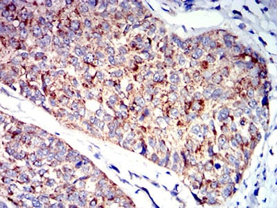 Figure 5:Immunohistochemical analysis of paraffin-embedded bladder cancer tissues using P2RY1 mouse mAb with DAB staining.