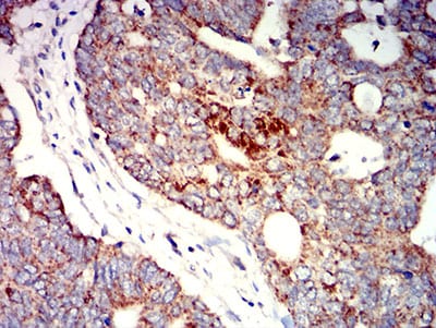 Figure 6:Immunohistochemical analysis of paraffin-embedded rectum cancer tissues using P2RY1 mouse mAb with DAB staining.