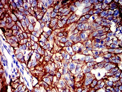 Figure 5:Immunohistochemical analysis of paraffin-embedded ovarian cancer tissues using CD147 mouse mAb with DAB staining.