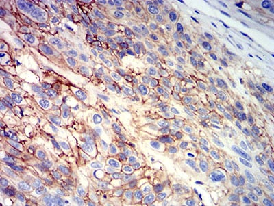 Figure 6:Immunohistochemical analysis of paraffin-embedded esophageal cancer tissues using CD147 mouse mAb with DAB staining.
