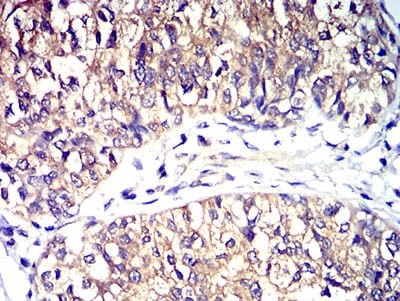 Figure 7:Immunohistochemical analysis of paraffin-embedded bladder cancer tissues using CD195 mouse mAb with DAB staining.