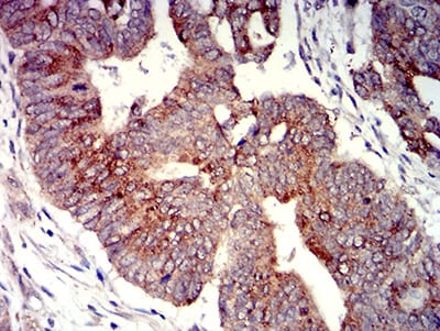 Figure 6:Immunohistochemical analysis of paraffin-embedded rectum cancer tissues using P2RY4 mouse mAb with DAB staining.