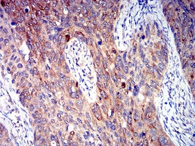 Figure 6:Immunohistochemical analysis of paraffin-embedded cervical cancer tissues using P2RY4 mouse mAb with DAB staining.