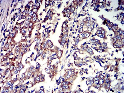 Figure 7:Immunohistochemical analysis of paraffin-embedded stomach cancer tissues using P2RY4 mouse mAb with DAB staining.