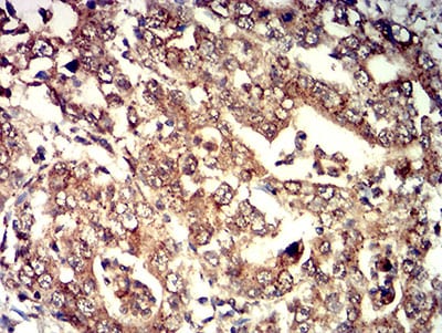 Figure 6:Immunohistochemical analysis of paraffin-embedded stomach cancer tissues using ELANE mouse mAb with DAB staining.