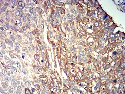 Figure 6:Immunohistochemical analysis of paraffin-embedded lung cancer tissues using P2RY14 mouse mAb with DAB staining.