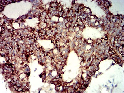 Figure 5:Immunohistochemical analysis of paraffin-embedded colon cancer tissues using P2RY14 mouse mAb with DAB staining.