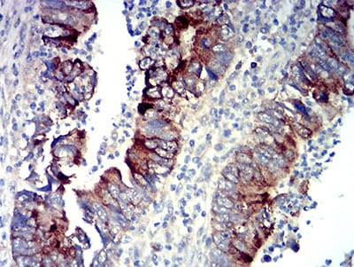 Figure 6:Immunohistochemical analysis of paraffin-embedded rectum cancer tissues using P2RY14 mouse mAb with DAB staining.