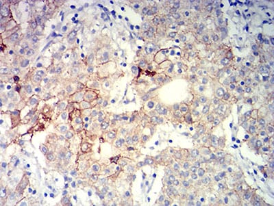 Figure 6:Immunohistochemical analysis of paraffin-embedded stomach cancer tissues using CD104 mouse mAb with DAB staining.