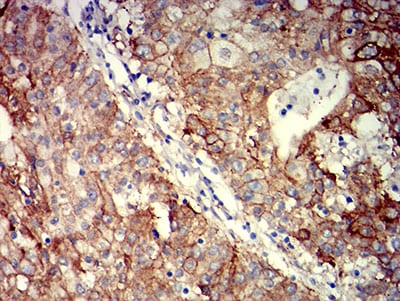 Figure 6:Immunohistochemical analysis of paraffin-embedded stomach cancer tissues using CD104 mouse mAb with DAB staining.