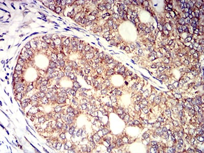 Figure 4:Immunohistochemical analysis of paraffin-embedded cervical cancer tissues using KIR3DL1 mouse mAb with DAB staining.