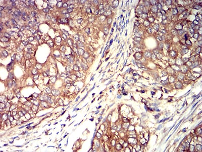 Figure 5:Immunohistochemical analysis of paraffin-embedded cervical cancer tissues using ACTR3 mouse mAb with DAB staining.