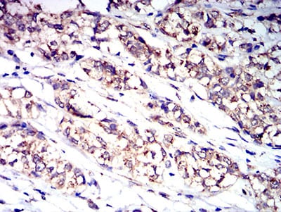 Figure 6:Immunohistochemical analysis of paraffin-embedded bladder cancer tissues using CD114 mouse mAb with DAB staining.