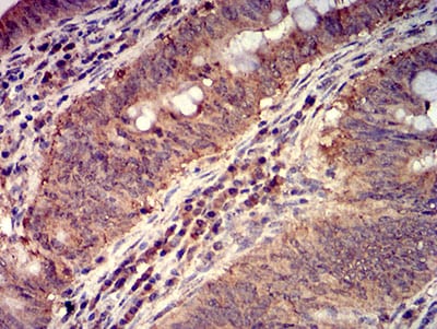 Figure 7:Immunohistochemical analysis of paraffin-embedded rectum cancer tissues using FOLR1 mouse mAb with DAB staining.