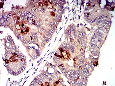 Figure 5:Immunohistochemical analysis of paraffin-embedded rectum cancer tissues using CD1C mouse mAb with DAB staining.