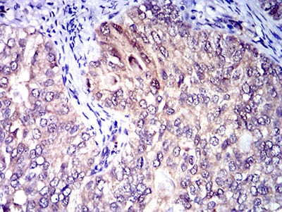 Figure 5:Immunohistochemical analysis of paraffin-embedded cervical cancer tissues using CD1C mouse mAb with DAB staining.