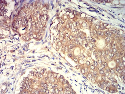 Figure 5:Immunohistochemical analysis of paraffin-embedded cervical cancer tissues using CD140a mouse mAb with DAB staining.