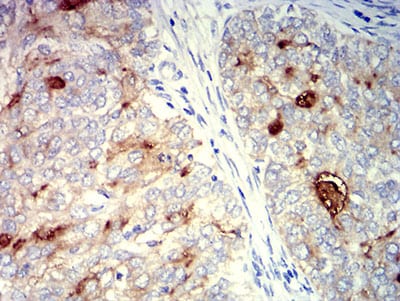 Figure 5:Immunohistochemical analysis of paraffin-embedded cervical cancer tissues using CD227 mouse mAb with DAB staining.