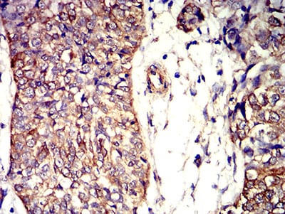 Figure 7:Immunohistochemical analysis of paraffin-embedded bladder cancer tissues using APC2 mouse mAb with DAB staining.