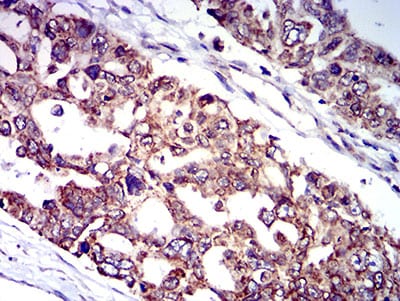 Figure 7:Immunohistochemical analysis of paraffin-embedded ovarian cancer tissues using CD129 mouse mAb with DAB staining.