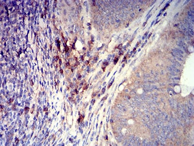 Figure 6:Immunohistochemical analysis of paraffin-embedded rectum cancer tissues using CD319 mouse mAb with DAB staining.