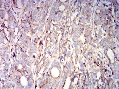 Figure 5:Immunohistochemical analysis of paraffin-embedded cervical cancer tissues using CD63 mouse mAb with DAB staining.