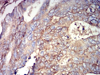 Figure 7:Immunohistochemical analysis of paraffin-embedded rectum cancer tissues using CD44 mouse mAb with DAB staining.