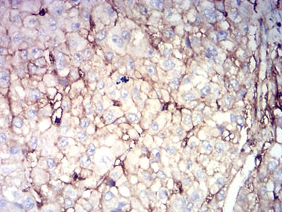 Figure 6:Immunohistochemical analysis of paraffin-embedded liver cancer tissues using CD44 mouse mAb with DAB staining.