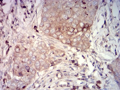 Figure 6:Immunohistochemical analysis of paraffin-embedded lung cancer tissues using CD66A mouse mAb with DAB staining.