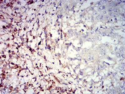 Figure 4:Immunohistochemical analysis of paraffin-embedded stomach cancer tissues using CD39 mouse mAb with DAB staining.