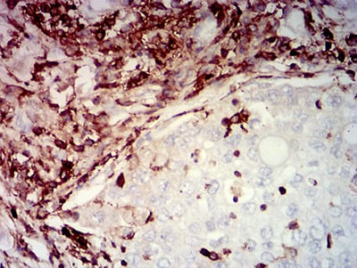 Figure 5:Immunohistochemical analysis of paraffin-embedded lung cancer tissues using CD45 mouse mAb with DAB staining.