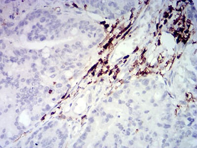 Figure 6:Immunohistochemical analysis of paraffin-embedded rectum cancer tissues using CD45 mouse mAb with DAB staining.