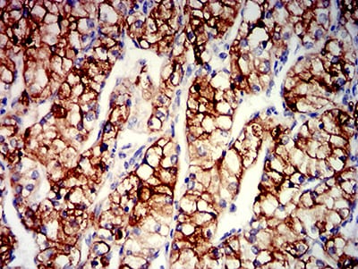 Figure 5:Immunohistochemical analysis of paraffin-embedded renal cancer tissues using CD203C mouse mAb with DAB staining.