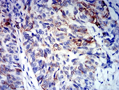 Figure 5:Immunohistochemical analysis of paraffin-embedded bladder cancer tissues using CD64 mouse mAb with DAB staining.