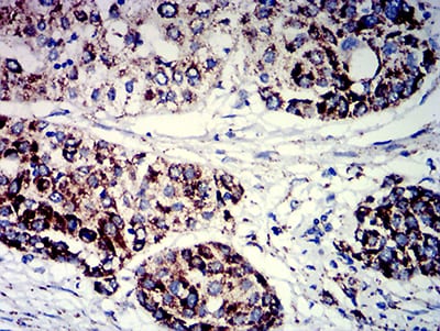 Figure 4:Immunohistochemical analysis of paraffin-embedded ovarian cancer tissues using PIGR mouse mAb with DAB staining.