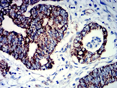 Figure 5:Immunohistochemical analysis of paraffin-embedded rectum cancer tissues using PIGR mouse mAb with DAB staining.