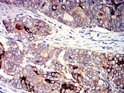 Figure 4:Immunohistochemical analysis of paraffin-embedded cervical cancer tissues using PIGR mouse mAb with DAB staining.