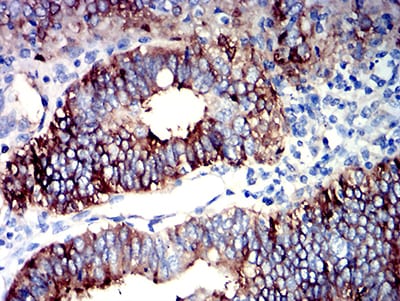 Figure 5:Immunohistochemical analysis of paraffin-embedded endometrial cancer tissues using PIGR mouse mAb with DAB staining.