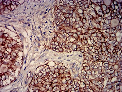 Figure 5:Immunohistochemical analysis of paraffin-embedded cervical cancer tissues using CD46 mouse mAb with DAB staining.