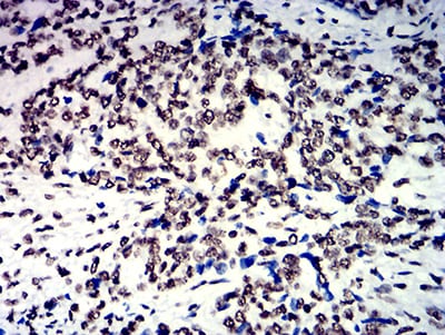 Figure 8:Immunohistochemical analysis of paraffin-embedded esophageal cancer tissues using NAGR1 mouse mAb with DAB staining.