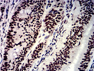 Figure 9:Immunohistochemical analysis of paraffin-embedded rectum cancer tissues using NAGR1 mouse mAb with DAB staining.