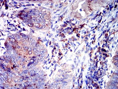 Figure 5:Immunohistochemical analysis of paraffin-embedded rectum cancer tissues using CD53 mouse mAb with DAB staining.