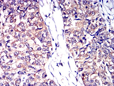 Figure 7:Immunohistochemical analysis of paraffin-embedded bladder cancer tissues using CD53 mouse mAb with DAB staining.