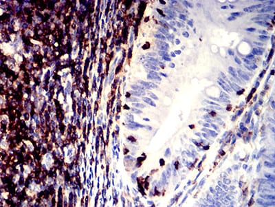 Figure 7:Immunohistochemical analysis of paraffin-embedded rectum cancer tissues using CD11a mouse mAb with DAB staining.