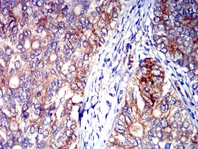 Figure 5:Immunohistochemical analysis of paraffin-embedded cervical cancer tissues using CD327 mouse mAb with DAB staining.