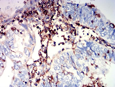 Figure 6:Immunohistochemical analysis of paraffin-embedded endometrial cancer tissues using CD97 mouse mAb with DAB staining.