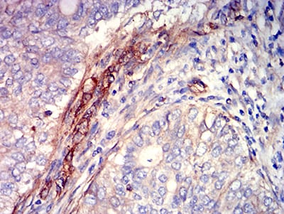 Figure 5:Immunohistochemical analysis of paraffin-embedded cervical cancer tissues using CD363 mouse mAb with DAB staining.