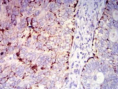 Figure 5:Immunohistochemical analysis of paraffin-embedded cervical cancer tissues using CD182 mouse mAb with DAB staining.