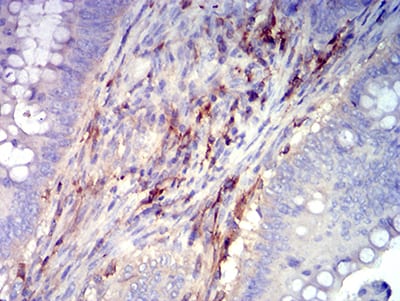 Figure 6:Immunohistochemical analysis of paraffin-embedded rectum cancer tissues using CD61 mouse mAb with DAB staining.