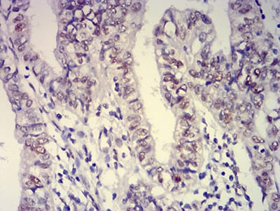 Figure 6:Immunohistochemical analysis of paraffin-embedded endometrial cancer tissues using ATXN1 mouse mAb with DAB staining.